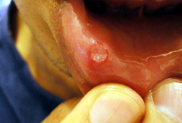 Blisters of the mouth